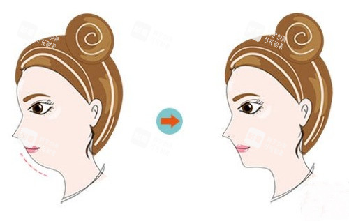 正頜前后示意圖