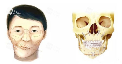 正頜手術(shù)對比圖