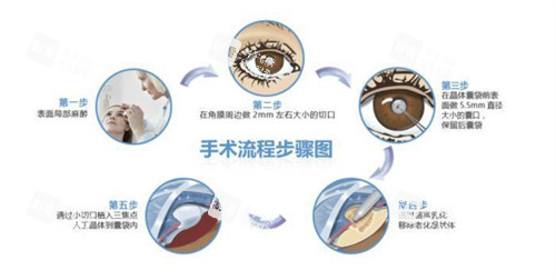 白內(nèi)障三焦點(diǎn)人工晶體手術(shù)過程 白內(nèi)障三焦點(diǎn)人工晶體手術(shù)過程