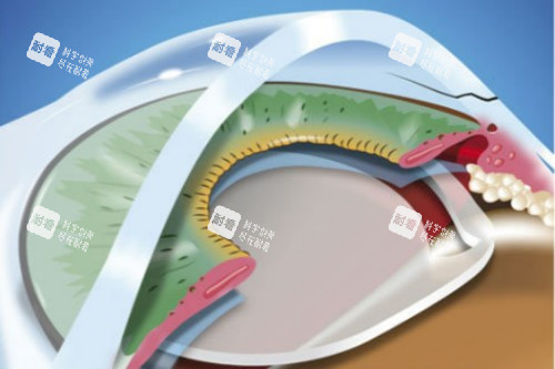 放入白內(nèi)障晶體 放入白內(nèi)障晶體