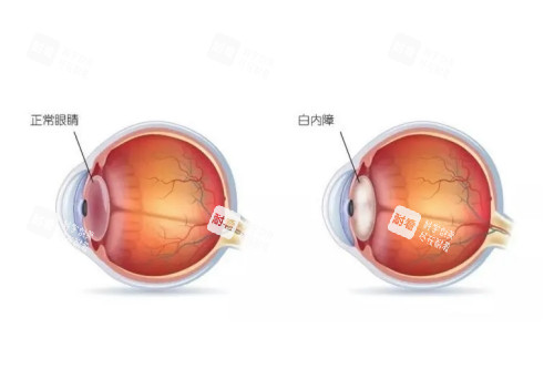 正常眼睛與白內(nèi)障眼鏡對比圖 正常眼睛與白內(nèi)障眼鏡對比圖