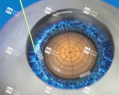 飛秒激光白內(nèi)障手術(shù)圖