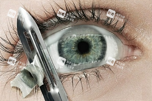 眼角膜割除眼睛局部圖