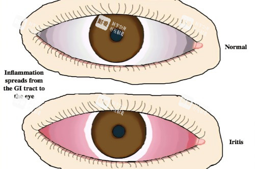 虹膜炎與健康眼睛對比
