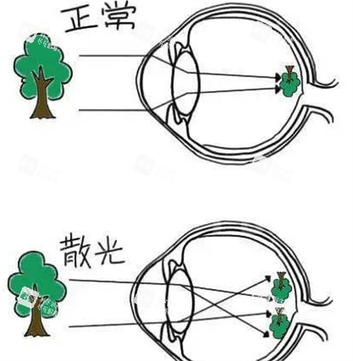 正常眼睛和散光眼睛呈現(xiàn)不同