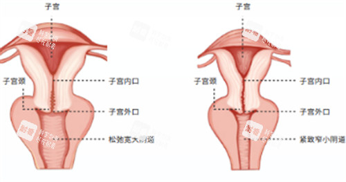 陰道緊縮術施術位置圖解