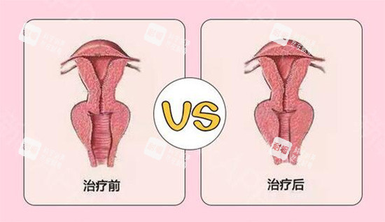 陰道緊縮針前后對比