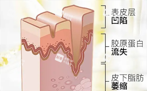 皮膚皺紋皮下組織剖面圖