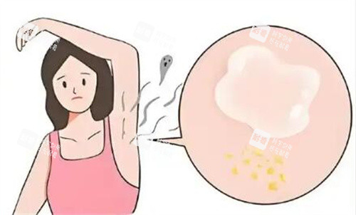 腋臭卡通圖照片示意圖