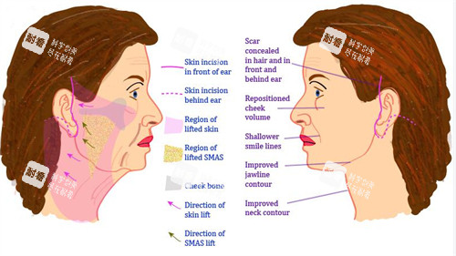 面部提升手術(shù)對(duì)比圖
