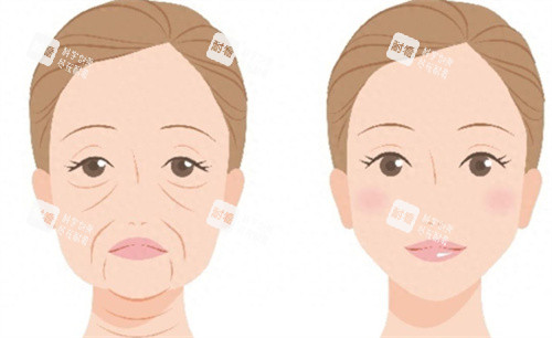 面部提升術(shù)