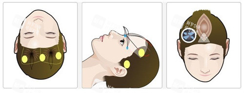 額頭提升術(shù)