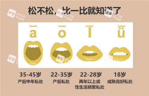 陰道松弛的程度對(duì)比