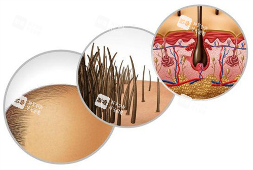 脂溢性脫發(fā)造成的問題