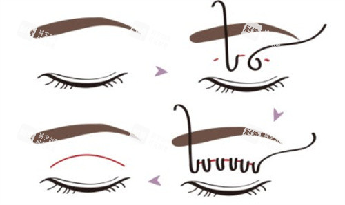 VLINE雙眼皮手術(shù)