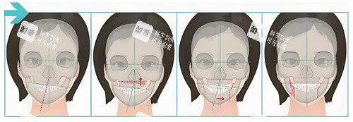 正頜手術(shù)手術(shù)步驟展示動(dòng)畫圖