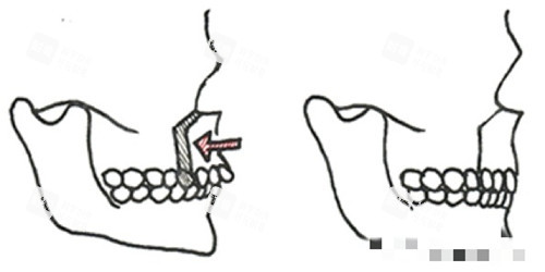 正頜手術(shù)圖片