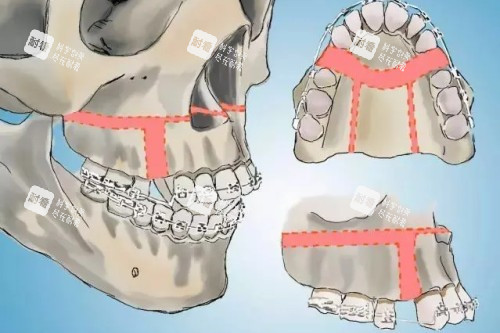 正頜手術(shù)示意圖