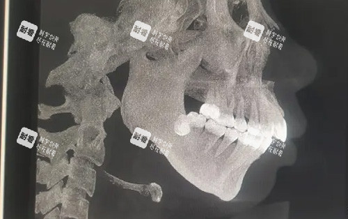 需要做正頜手術(shù)的骨骼圖