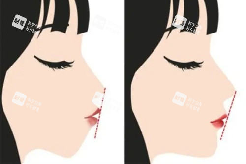 正頜手術(shù)前后的對(duì)比圖