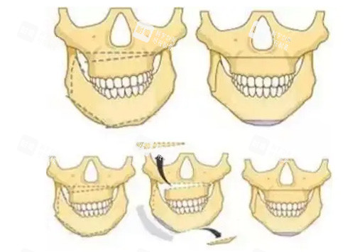 正頜手術(shù)卡通照片