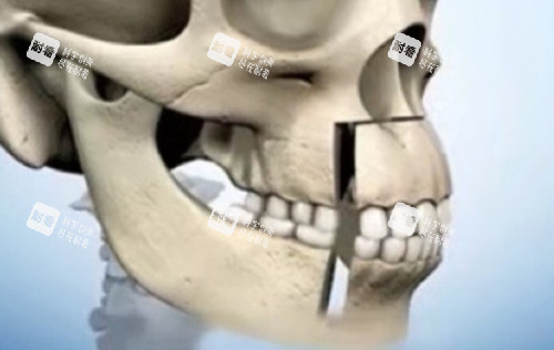 正頜手術(shù)圖示