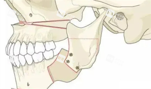 正頜手術(shù)后的形狀
