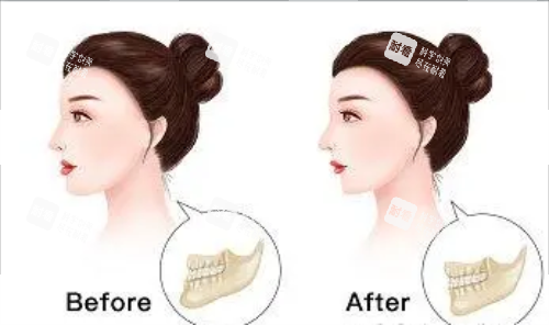 正頜手術(shù)后的成效圖片