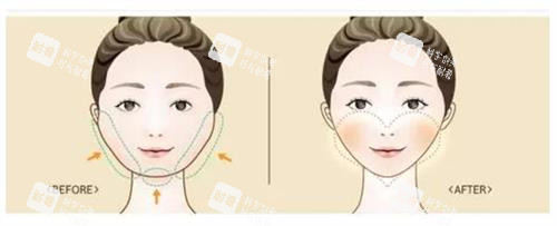 磨骨手術(shù)前后的區(qū)別