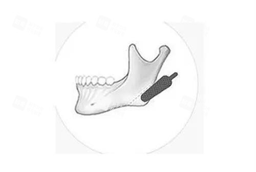 磨骨手術(shù)示意圖