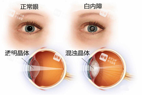 白內(nèi)障與正常眼睛卡通對(duì)比圖