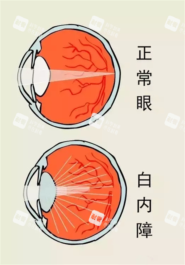 正常眼睛和白內(nèi)障眼睛區(qū)別 正常眼睛和白內(nèi)障眼睛區(qū)別