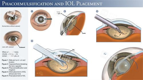 超聲乳化白內(nèi)障手術(shù)細節(jié)圖 超聲乳化白內(nèi)障手術(shù)細節(jié)圖