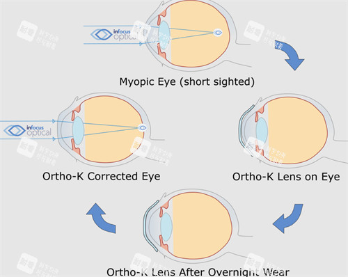 角膜塑形鏡前后對比