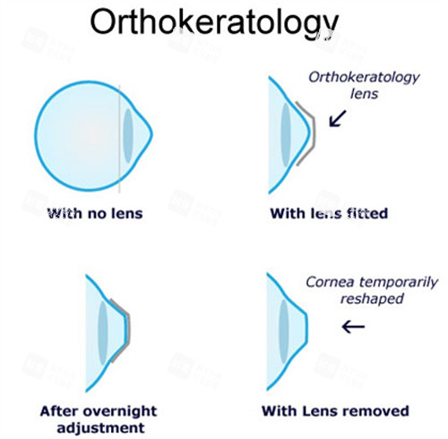 角膜塑形鏡工作流程