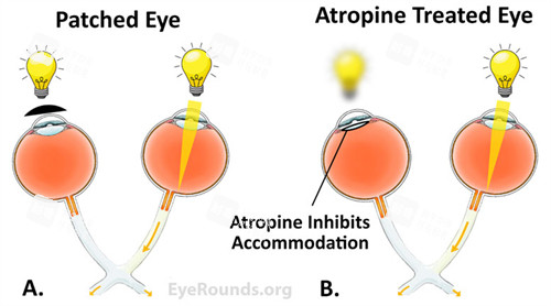 正常眼睛和弱視眼睛的區(qū)別 正常眼睛和弱視眼睛的區(qū)別