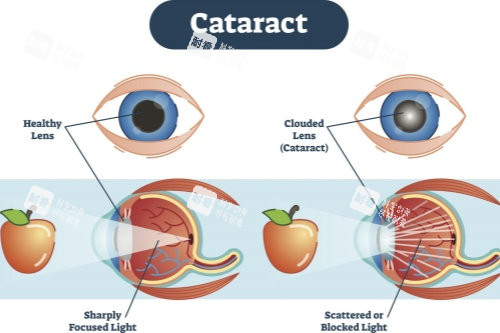 正常眼睛與白內(nèi)障眼睛視物對比圖 正常眼睛與白內(nèi)障眼睛視物對比圖