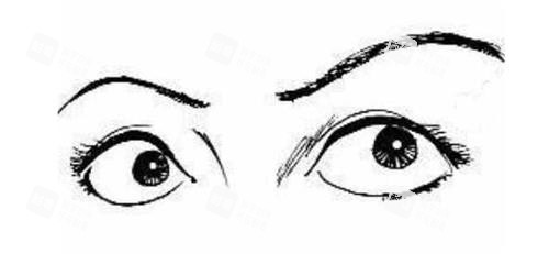 眼睛外凸示意圖