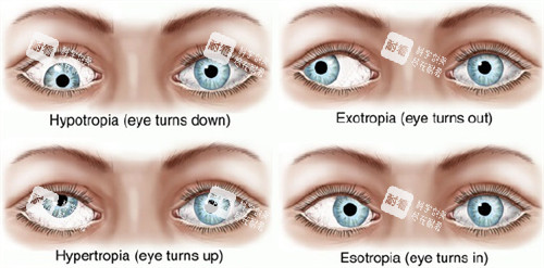 不同眼睛斜視和正常眼睛的對(duì)比