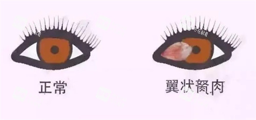 翼狀胬肉與正常眼睛對(duì)比圖
