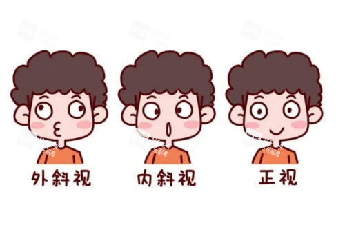 眼睛內(nèi)斜視外斜視正常眼睛對(duì)比圖