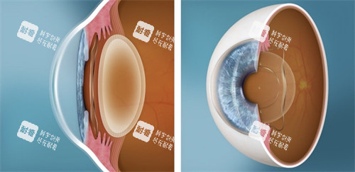 人工晶體植入眼睛對(duì)比