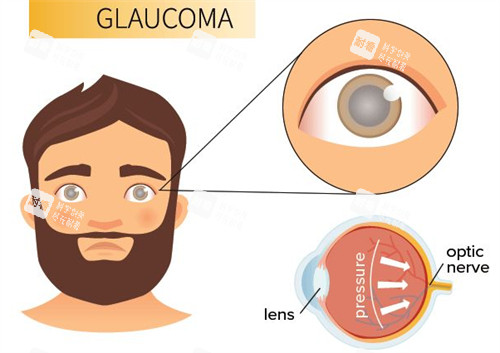 青光眼的表現(xiàn)