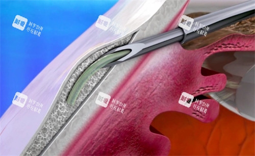 青光眼手術(shù)