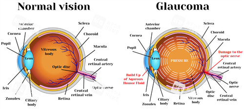正常眼睛和青光眼的對(duì)比圖