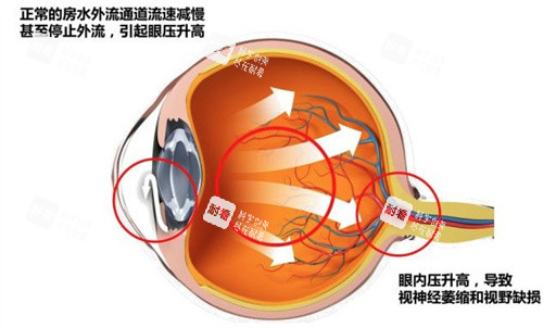 什么是急性閉角型青光眼