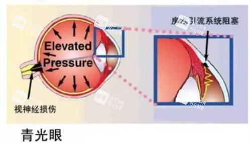 青光眼是什么原因?qū)е碌? title=