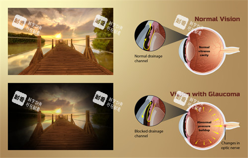 青光眼動(dòng)畫圖示