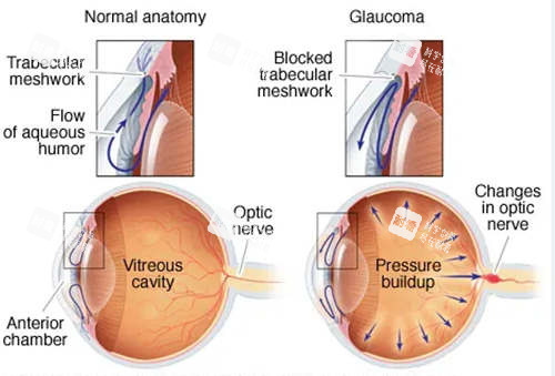 青光眼對(duì)比圖