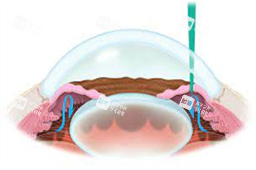 虹膜切除術(shù) 青光眼
